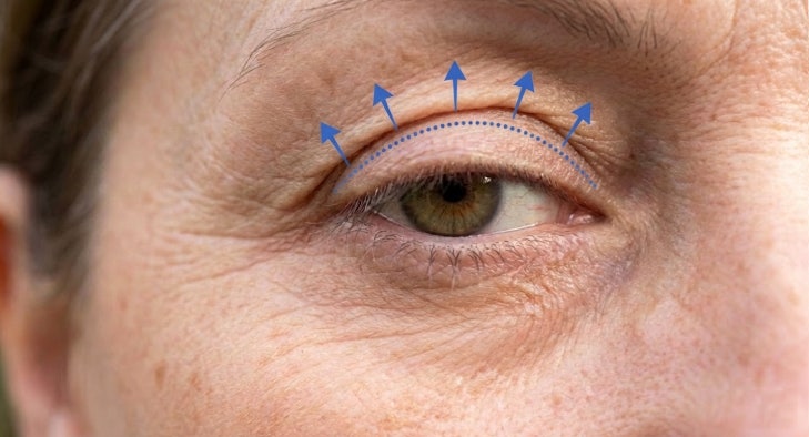 Upper Blepharoplasty for Patients in Their 50s: Understanding Different Types of Eyelid Ptosis