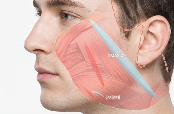 Male Facelift Selection Criteria: Why a Different Approach is Needed Compared to Female Surgery 사진 7