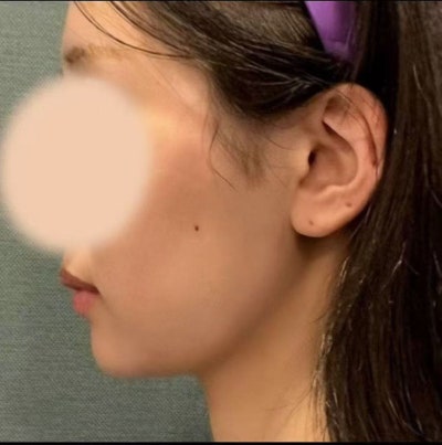 Want to See Real Results from Anti-Aging Surgery? Understanding the Difference Between Wrinkle Improvement and Lifting 사