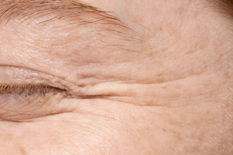 Want to See Real Results from Anti-Aging Surgery? Understanding the Difference Between Wrinkle Improvement and Lifting
