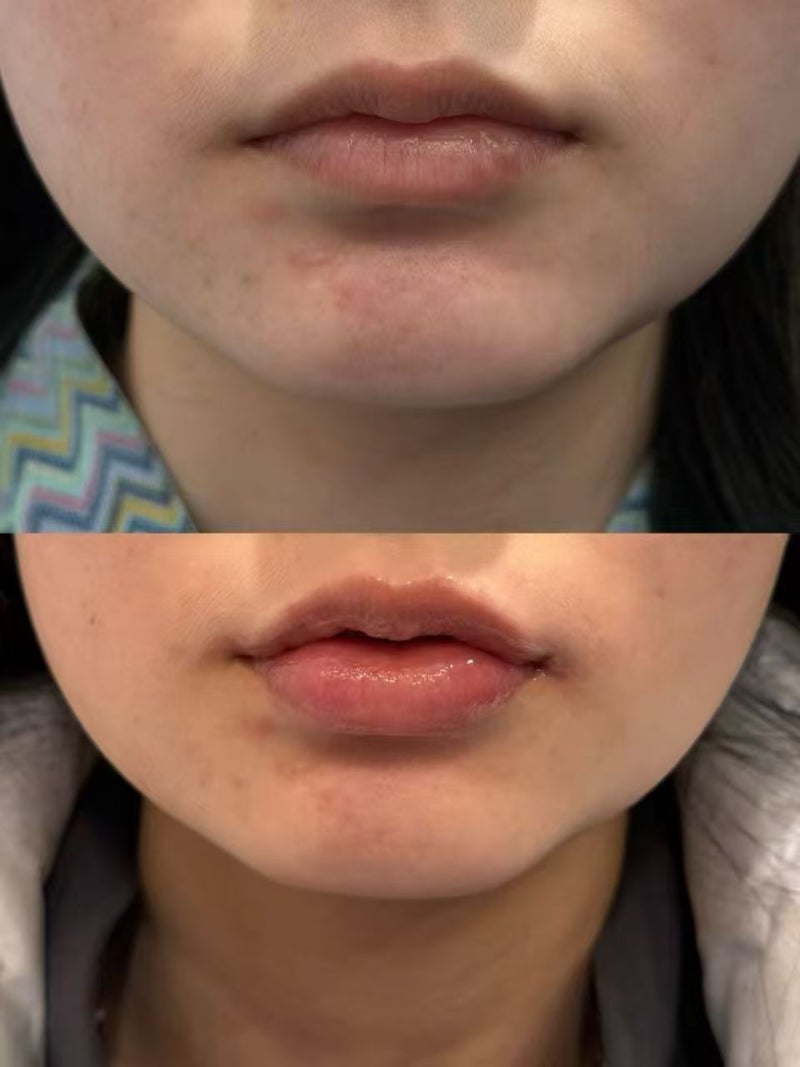 Nasolabial Fold Treatment: Botox vs. Filler vs. Thread Lift vs. RF Lifting – A Guide to Choosing 사진 5