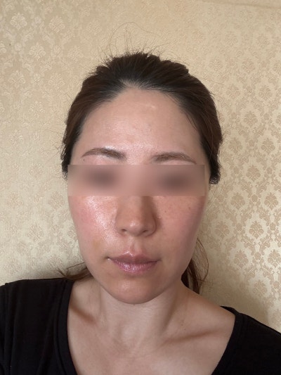 Nasolabial Fold Treatment: Botox vs. Filler vs. Thread Lift vs. RF Lifting – A Guide to Choosing 사진 10