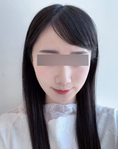 Mint Thread Lift (12 Threads): The Design Criteria That Make a Difference in Results 사진 11