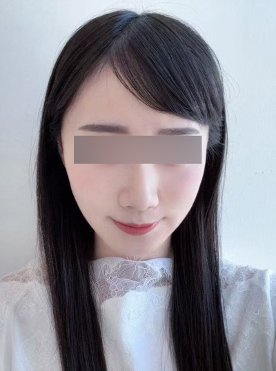 Sagging Cheeks and Nasolabial Folds: Why You Should Address Cheek Sagging First, Not Just the Folds 사진 8
