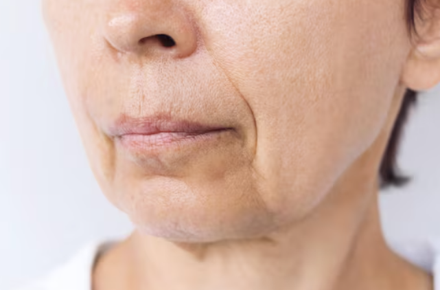 Sagging Cheeks and Nasolabial Folds: Why You Should Address Cheek Sagging First, Not Just the Folds