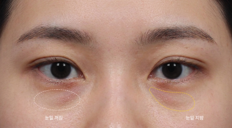 Lower Blepharoplasty for 40s, 50s, and 60s: Tailored Approaches for Under-Eye Fat, Sagging, and Wrinkles