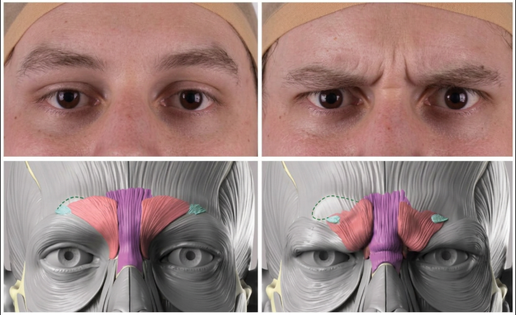 Forehead Thread Lift Results: Eyebrow Position is Key