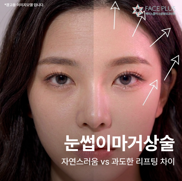 Eyebrow and Forehead Lift: The Difference Between Natural and Over-Lifted Results