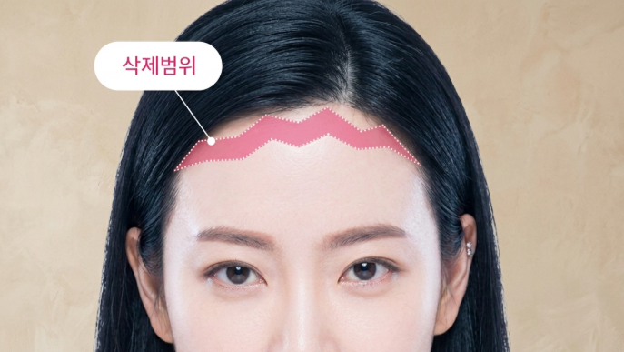 Eyebrow and Forehead Lift: The Difference Between Natural and Over-Lifted Results