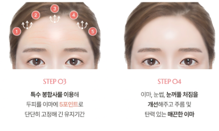 Eyebrow and Forehead Lift: The Difference Between Natural and Over-Lifted Results 사진 4