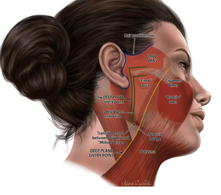 This One Article is Better Than 100 Ponytail Lift Reviews – Cost, Scars, Before & After Comprehensive Guide 사진 9