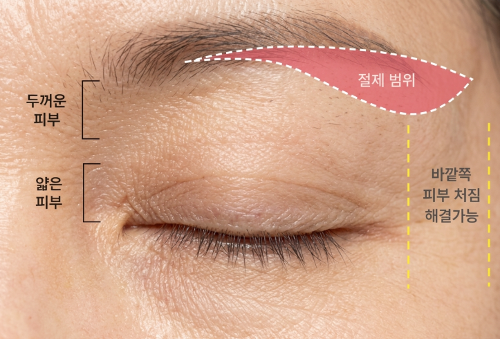 When Does a Sub-Brow Lift Look Natural? Explaining Swelling, Scars, and Eyebrow Position Changes 사진 5
