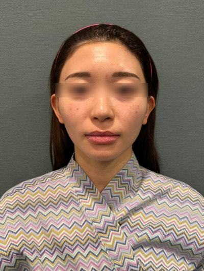 Mint Thread Lift Duration: How It Changes Over Time 사진 10