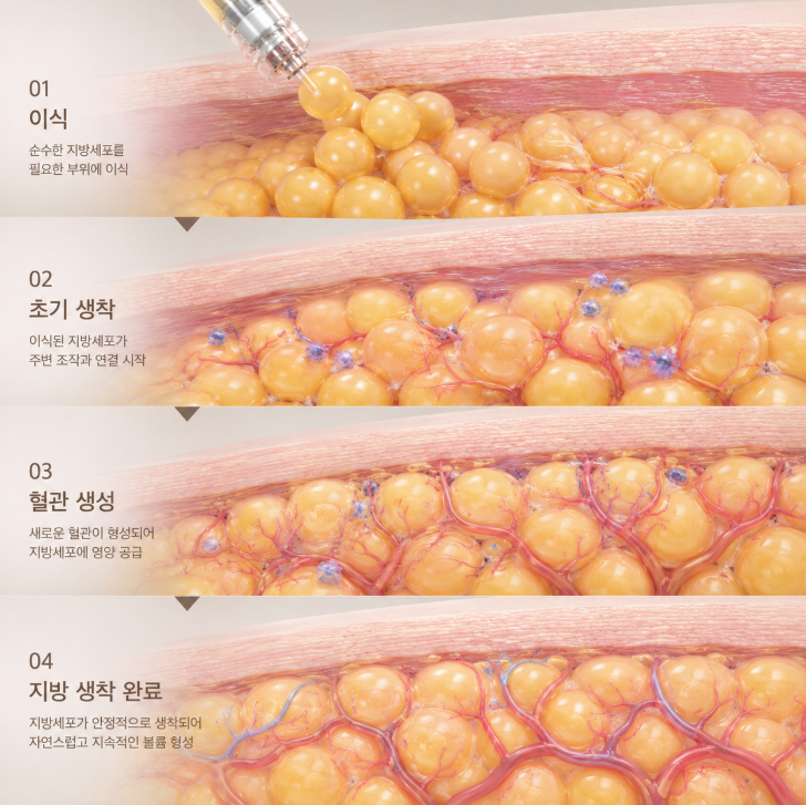 Facial Fat Grafting Side Effects: Understanding Possibility and Management 사진 8