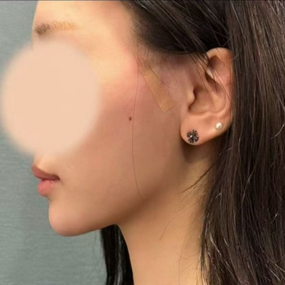 Perbedaan Mint Thread vs Silhouette Soft, Penjelasan Durasi, Efek, dan Jenis Benang 사진 10
