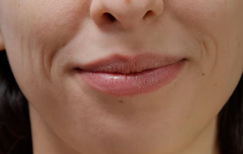 Recommended Nasolabial Fold Treatment: Thread Lift vs. Filler – Which is More Natural?