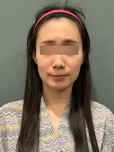 Durasi Efek Mint Thread Lift dan Perbandingan Jenis Thread Lift, Penjelasan Perbandingan Efek 사진 9
