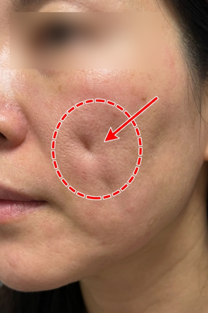 Why You Shouldn't Massage Dimples After Thread Lift, Explaining Potential Thread Movement 사진 3