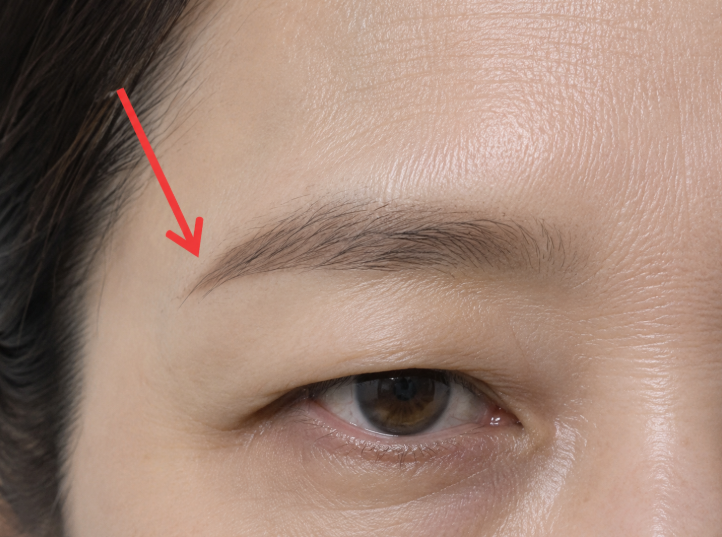 Droopy Eyebrow Thread Lift vs. Eyebrow Lift: Differences, Effects, and Recovery Period Explained 사진 3