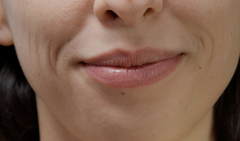 Reasons Why Nasolabial Fold Thread Lifts Have a Shorter Duration, Surprisingly, It's Because of This 사진 6
