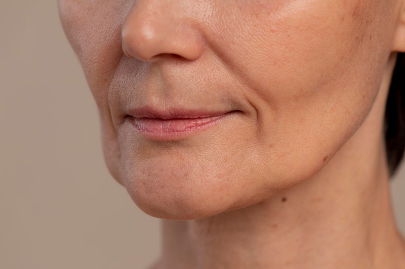 Reasons Why Nasolabial Fold Thread Lifts Have a Shorter Duration, Surprisingly, It's Because of This 사진 2