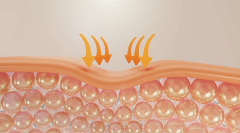 Reasons Why Nasolabial Fold Thread Lifts Have a Shorter Duration, Surprisingly, It's Because of This