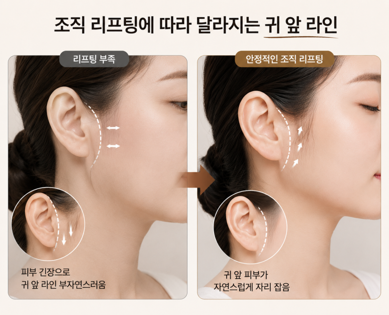 The Key to Naturally Concealing Mini-Facelift Scars is the ‘Direction of Pull’ 사진 8