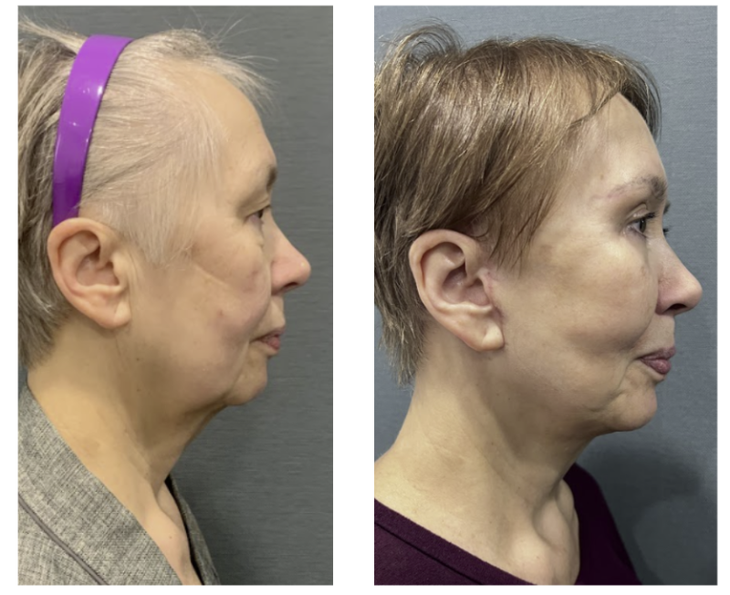 Mini Facelift vs. Full Facelift: What's the Difference? Effects, Scars, and Longevity Explained 사진 9