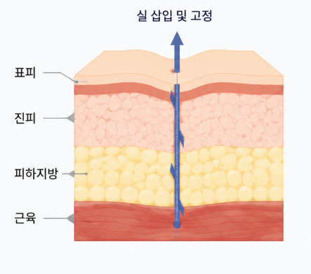 Nasolabial Fold Filler vs. Thread Lift: Why the Approach Differs for the Same Concern 사진 7