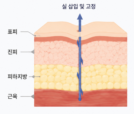 Cara Alami Mengatasi Pipi Cekung dan Kendur dengan Thread Lift 사진 4