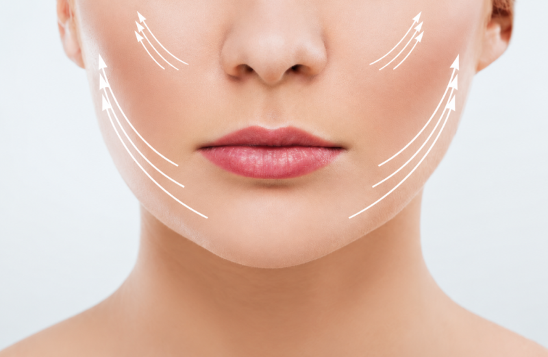 Marionette Line Thread Lift: A Must-Consider Procedure If You're Concerned About Wrinkles 사진 5