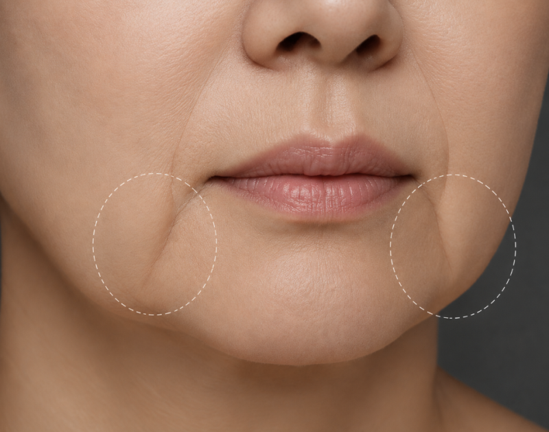Marionette Line Thread Lift: A Must-Consider Procedure If You're Concerned About Wrinkles 사진 3