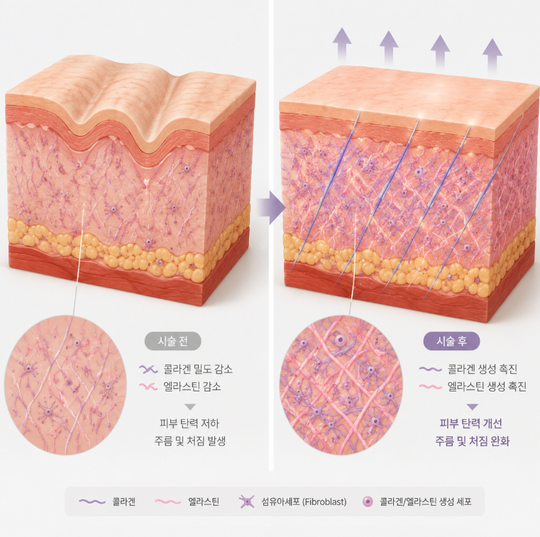 Marionette Line Thread Lift: A Must-Consider Procedure If You're Concerned About Wrinkles 사진 8