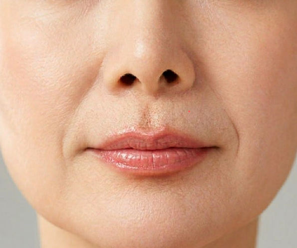 Marionette Line Treatment: So Many Options? A Custom Recommendation Guide Just for You 사진 3