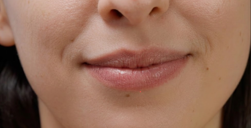 Nasolabial Fold Lifting: Why Thread Lifts Are Necessary If Fillers Alone Weren't Enough 사진 3