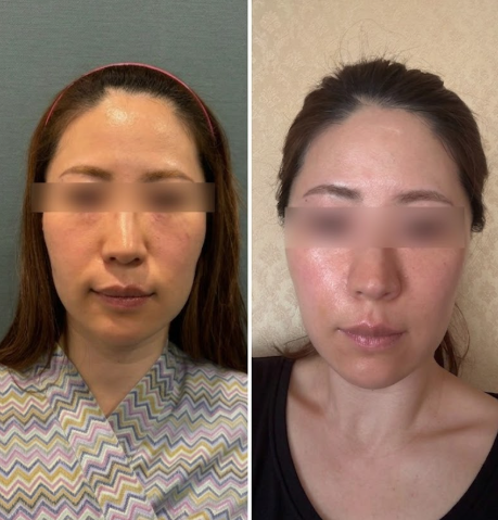 Nasolabial Fold Lifting: Why Thread Lifts Are Necessary If Fillers Alone Weren't Enough 사진 9