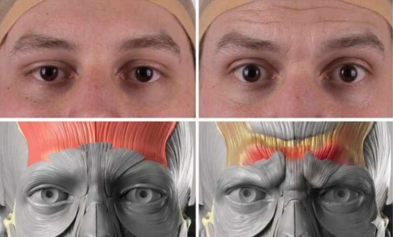 Forehead Lift Effects: How Your Facial Impression Can Change 사진 5