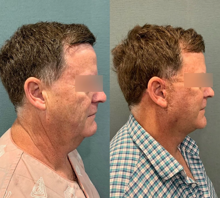 Facelift Surgery: Why Satisfaction Lasts at a Reputable Clinic 사진 9