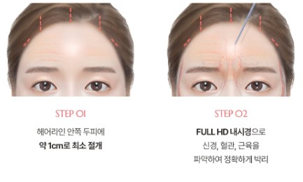 Karina Forehead Lift, Apa Ciri-ciri Garis Wajah yang Menarik Perhatian Orang? 사진 9