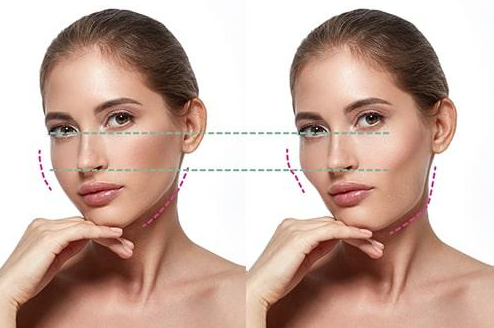 Midface Reduction Procedures: Why Your Face Looks Different Even If Its Length Remains the Same 사진 5