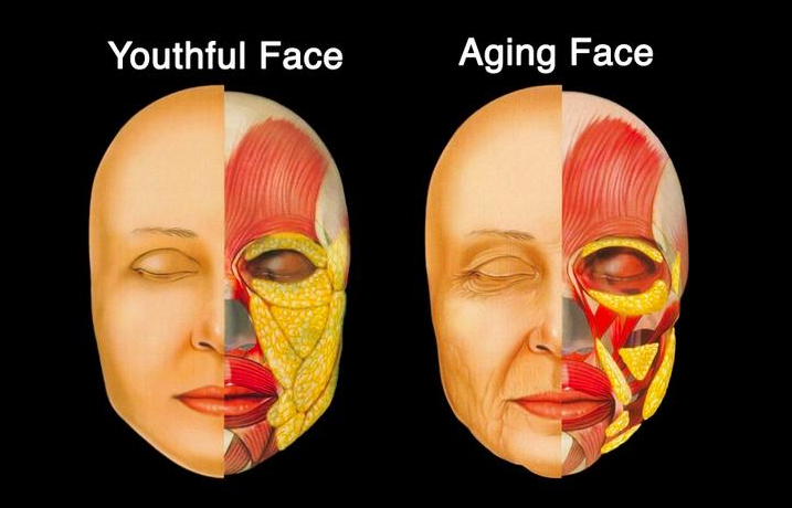 Marionette Line Treatment: Why Filling Wrinkles Alone Isn't Enough 사진 4