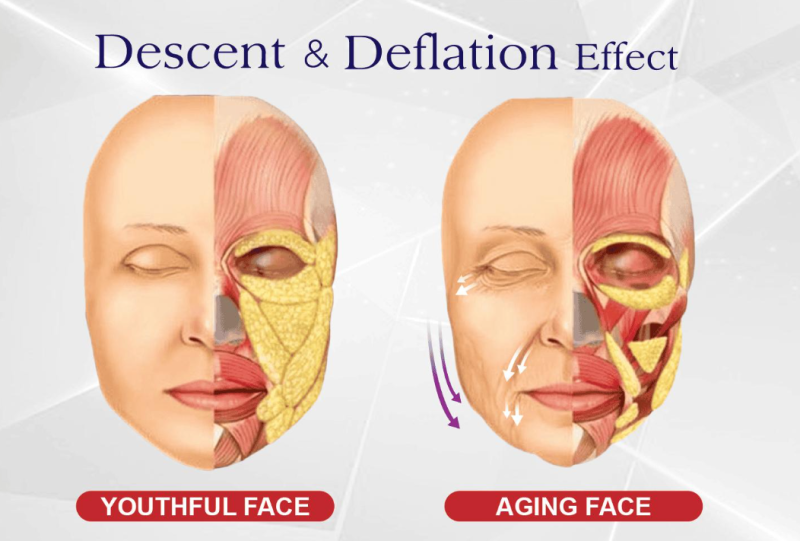 Marionette Line Treatment: Why Filling Wrinkles Alone Isn't Enough 사진 8