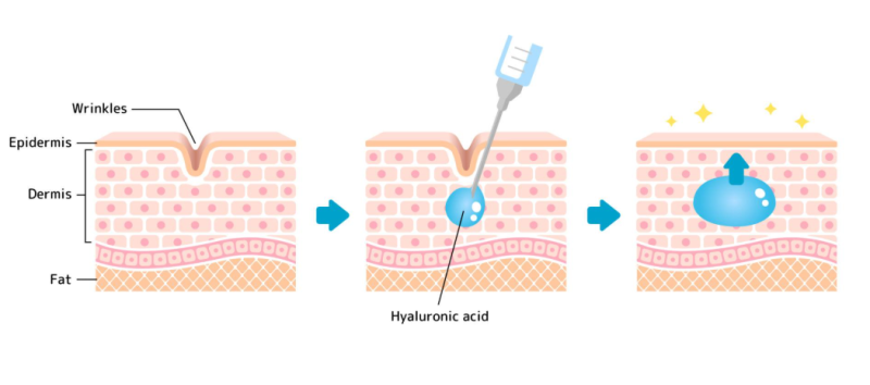 Marionette Line Treatment: Why Filling Wrinkles Alone Isn't Enough 사진 7