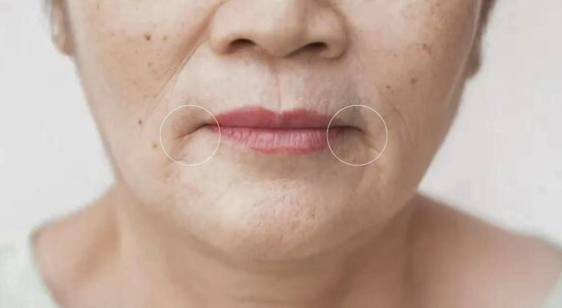 Marionette Line Treatment: Why Filling Wrinkles Alone Isn't Enough 사진 6