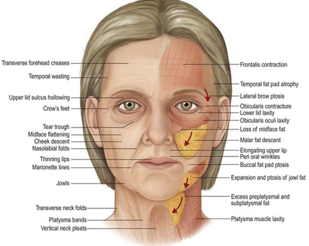 Marionette Line Treatment: Why Filling Wrinkles Alone Isn't Enough 사진 5