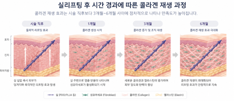 Can Gangnam Thread Lift Make a Difference in Just One Session? Realistic Expectations 사진 11