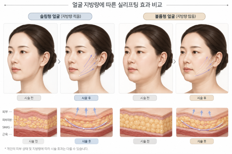 Can Gangnam Thread Lift Make a Difference in Just One Session? Realistic Expectations