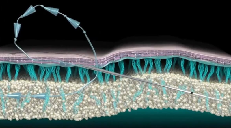 Nasolabial Fold Thread Lift: Results May Vary with the Severity of Nasolabial Folds