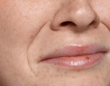 Types of Nasolabial Fold Procedures: When to Choose Mint, Cavurn, or Aptos Threads? 사진 3