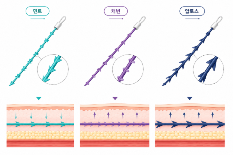 Types of Nasolabial Fold Procedures: When to Choose Mint, Cavurn, or Aptos Threads? 사진 5